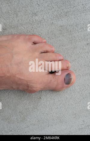 gros plan de l'ongle de l'orteil ecchymose hemtoma. orteil clou ecchymose hemtoma sur le pied. orteil clou ecchymose hemtoma. Banque D'Images