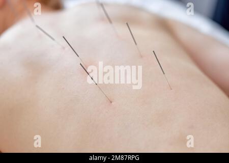 acupuncture thérapie sur la colonne vertébrale, épaules pour femme cliente. femme en cours d'acupuncture avec des aiguilles fines insérées dans la peau mince du corps en cl Banque D'Images