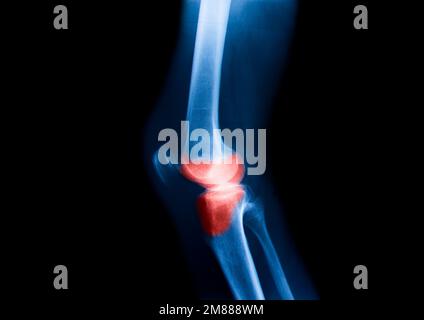 Écran de radiographie du genou ou de la jambe avec douleur au cercle rouge Banque D'Images