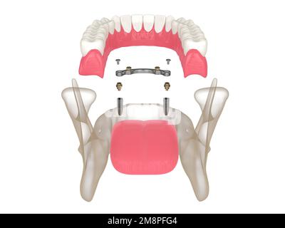 3d le rendu de la barre retient l'installation de la prothèse amovible soutenue par deux implants sur fond blanc Banque D'Images