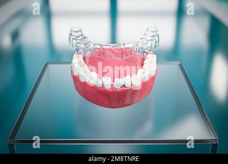 Dispositif orthodontique d'alignement transparent au-dessus des dents coulées. 3d illustration d'une forme en plastique utilisée pour régler les dents. Banque D'Images