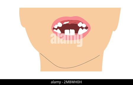 Un garçon sourit la dent manquante en raison du changement des dents du lait. Illustration minimaliste simple de la bouche de bébé avec jeu de dents incomplet. Illustration de Vecteur