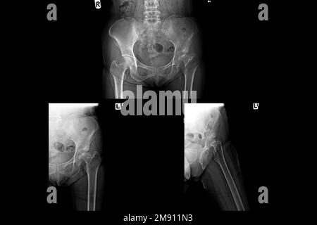 Film radiographique du bassin humain et des articulations de la hanche Banque D'Images