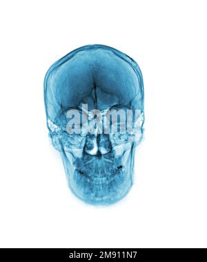 Filmer les rayons X du crâne humain normal sur un arrière-plan isolé Banque D'Images