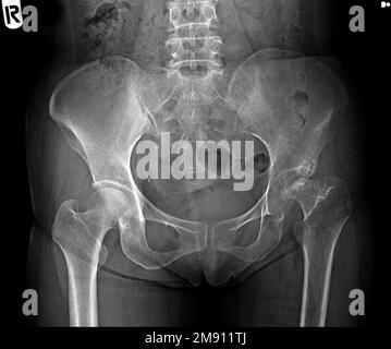 Film radiographique du bassin humain et des articulations de la hanche Banque D'Images