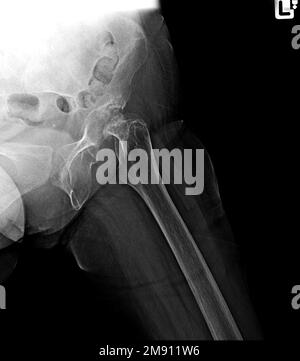 Film X-ray faciture des articulations de la hanche, fracture du cou du fémur Banque D'Images