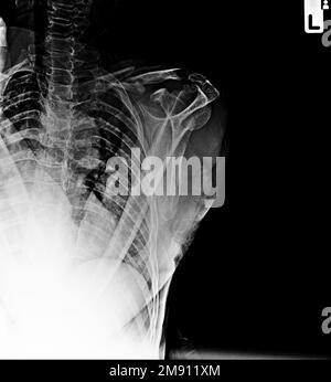 Film X-ray clavicule AP montrent fracture clavicule osseuse Banque D'Images
