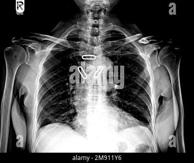 Figure de la splinte de clavicule de forme 8. Vue AP de la clavicule à rayons X. Banque D'Images