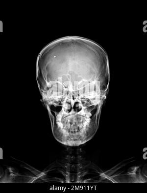Filmer les rayons X du crâne humain normal sur un arrière-plan isolé Banque D'Images