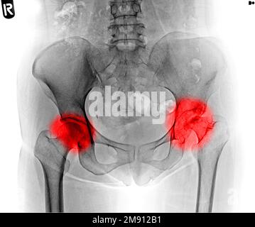 Film de rayons X du bassin humain et des articulations de la hanche du visage dans la zone rouge Banque D'Images