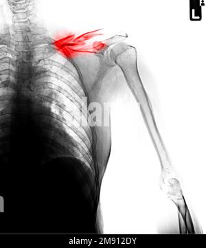 Film X-ray clavicule AP montrent fracture clavicule osseuse Banque D'Images