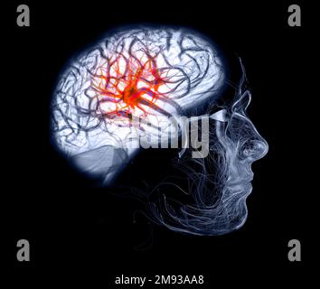 Douleur dans la tête, le cerveau et les synapses, problèmes cognitifs, déficit mental. Anévrisme. Maladies dégénératives affectant la région du cerveau. Parkinson Banque D'Images