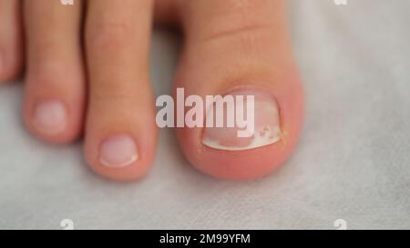 Gros plan sur un ongle endommagé, faible profondeur de champ. Banque D'Images