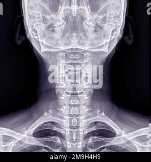 Radiographie du rachis cervical ou radiographie du rachis cervical vue AP pour l'hernie et la spondylose intervertébrales diagnostiques. Banque D'Images