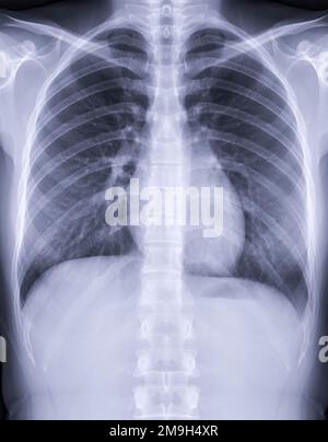 Radiographie thoracique pour le dépistage de la tuberculose, de la tuberculose et du covid-19. Banque D'Images