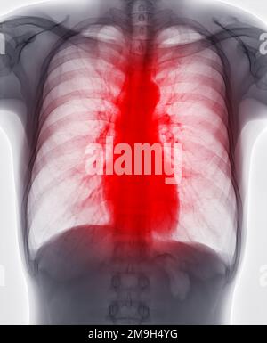 Radiographie thoracique pour le dépistage de la tuberculose, de la tuberculose et du covid-19. Banque D'Images