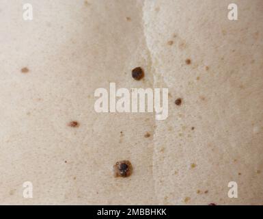 Image de la partie de dos d'une femme avec mélanome et kératose séborrhéique Banque D'Images