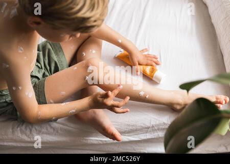 Jeune enfant avec la varicelle. Enfant malade avec la varicelle. Virus de la varicelle ou éruption de bulle de Chickenpox sur l'enfant. Portrait d'un petit garçon avec la varicelle. Banque D'Images