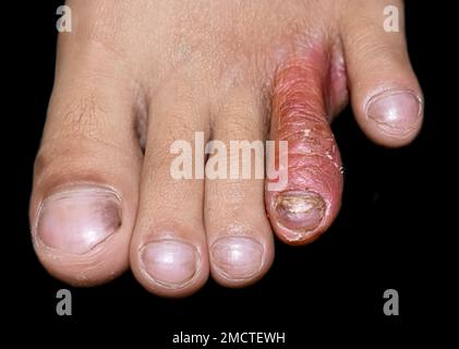 Tinea Pedis ou ou pied d'athlète ou infection fongique sur les orteils de l'enfant asiatique, birman. Il s'agit d'une infection superficielle de dermatophyte limitée au ski glabre Banque D'Images