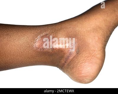 Cicatrice hypertrophique à la jambe de l'enfant asiatique. Isolé sur blanc. Banque D'Images