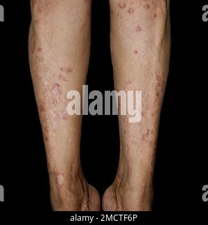 Infection fongique appelée tinea corporis dans la jambe de la femme asiatique. Ver annelé répandu sur le membre inférieur. Banque D'Images