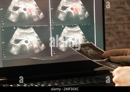 Échographie de l'abdomen d'une femme sur un écran d'ordinateur portable dans un bureau de médecin, diagnostic d'une douleur abdominale, médecine Banque D'Images