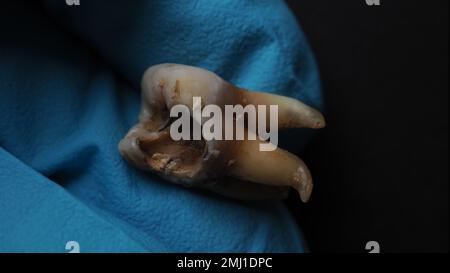 Carie dentaire et main de dentiste avec gant et fond noir. Photo macro d'une dent décalées jusqu'à la racine après l'extraction du dentiste. Anatomie réelle des dents Banque D'Images