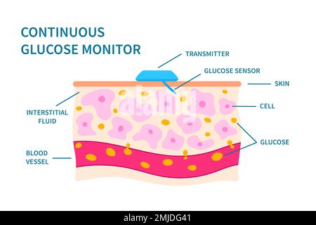 Moniteur de glycémie continue, illustration Banque D'Images