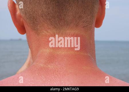 L'homme a reçu des coups de soleil sur la mer. La peau se déteint. Protection de la peau contre le soleil. Banque D'Images