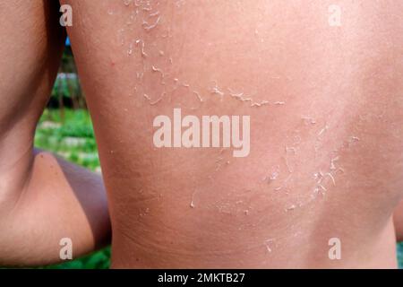 L'homme a reçu des coups de soleil sur la mer. La peau se déteint. Protection de la peau contre le soleil. Banque D'Images