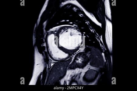 IRM cardiaque ou cardiaque IRM cardiaque en vue petit axe montrant les coupes transversales du ventricule gauche et droit pour le diagnostic de la maladie cardiaque. Banque D'Images