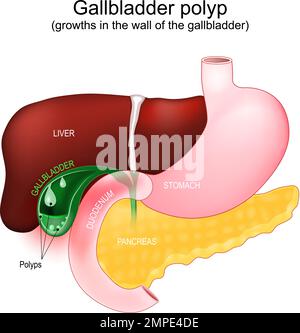 Coupe transversale d'une vésicule biliaire avec polypes. Accumulations anormales de tissu de la membrane muqueuse, croissances dans la paroi de la vésicule biliaire. Partie d'un humain Illustration de Vecteur
