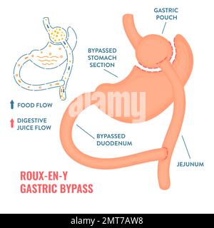 Roux-en-y déviation gastrique chirurgie bariatrique perte de poids infographiques Illustration de Vecteur