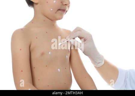 Médecin appliquant de la crème sur la peau du petit garçon avec la varicelle sur fond blanc, gros plan. Virus varicelle-zona Banque D'Images