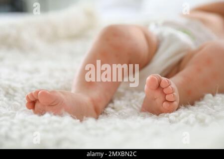 Petit enfant avec une éruption rouge sur le lit, gros plan. Allergies de bébé Banque D'Images