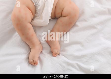 Petit enfant avec une éruption rouge sur le lit, vue de dessus. Allergies de bébé Banque D'Images