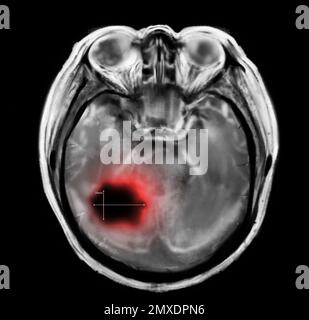 Rayons X du patient atteint d'un cancer du cerveau. Illustration Banque D'Images