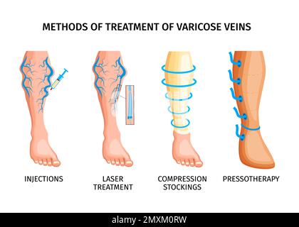 Méthodes de traitement des varices affiche réaliste représentant des injections traitement au laser bas de compression pressothérapie illustration vectorielle Illustration de Vecteur