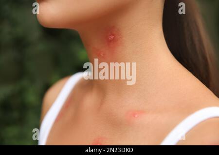 Femme avec piqûres d'insectes sur le corps à l'extérieur, vue rapprochée Banque D'Images