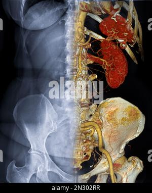 Angiographie par TDM DE L'AORTE ABDOMINALE 3D, fusion avec l'image de l'abdomen à rayons X. Banque D'Images