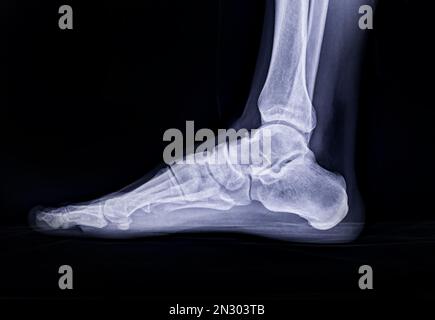 Image radiographique du pied vue latérale isolée sur fond noir. Banque D'Images