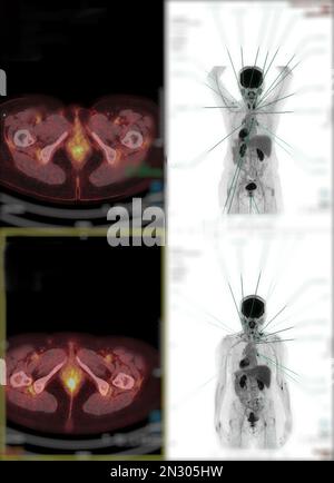 La tomographie par émission de positrons (TEP) CT scan utilise un médicament radioactif (traceur) pour montrer l'activité métabolique normale et anormale de tout le corps humain Banque D'Images