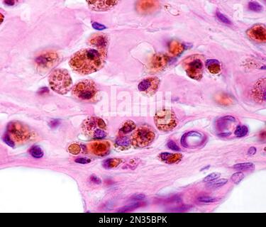 Macrophages fortement marqués avec du fer colloïdal. Le fer colloïdal peut être utilisé comme coloration vitale pour marquer les macrophages. Le fer colloïdal circulant est phago Banque D'Images