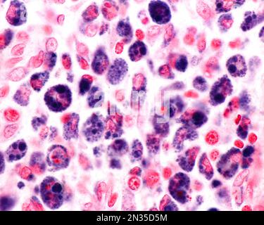 Micrographe à fort grossissement montrant les macrophages d'une zone d'inflammation fortement marquée par le bleu de Trypas. Le bleu de trypan est une tache vitale qui peut être dedans Banque D'Images