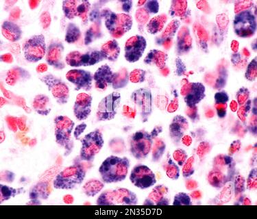 Micrographe à fort grossissement montrant les macrophages d'une zone d'inflammation fortement marquée par le bleu de Trypas. Le bleu de trypan est une tache vitale qui peut être dedans Banque D'Images