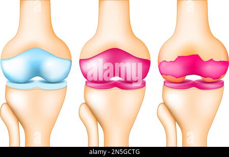 Genou humain en bonne santé, inflammation articulaire, arthrose ou maladie dégénérative des articulations. stade de la destruction du cartilage du genou. illustration vectorielle Illustration de Vecteur