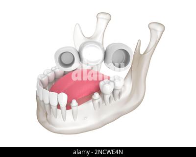 3d rendu de la mandibule avec pont dentaire sur les dents molaires et prémolaires Banque D'Images