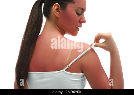 Femme avec une peau brûlée de soleil sur fond blanc Banque D'Images