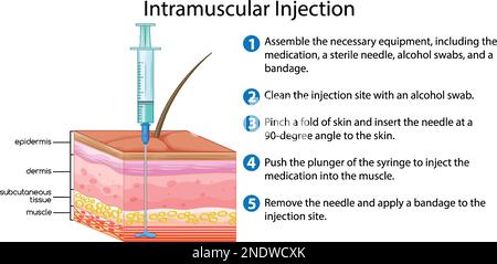 Injection intramusculaire avec illustration d'explication Illustration de Vecteur