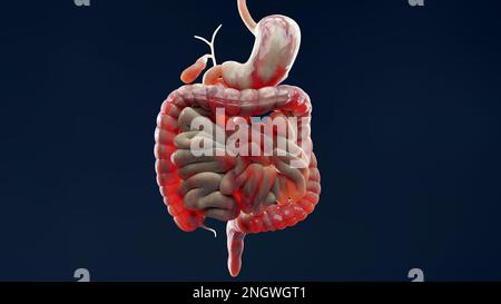 Homme souffrant de la maladie de crohns, anatomie masculine, inflammation gros intestin, Sigmoïd Colon, parties du système digestif humain, rendu 3D Banque D'Images